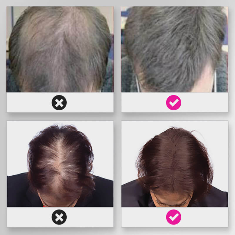EELHOE HAIR™  Puder przeciw wypadaniu włosów i szybkie wypełnienie linii włosów